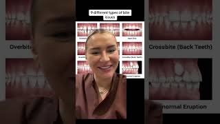Comment what you have a send to your friends! #braces #teeth #crowding #openbite #overbite