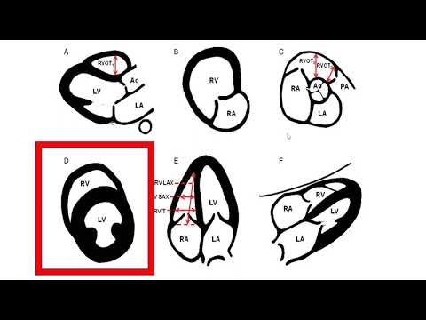 Image of RV Dysfunction and Sepsis