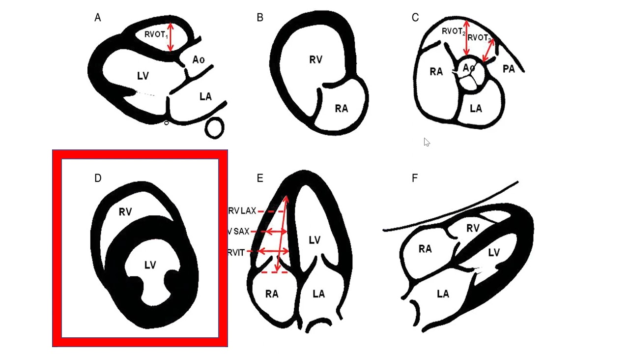 Дисфункция ПЖ и сепсис