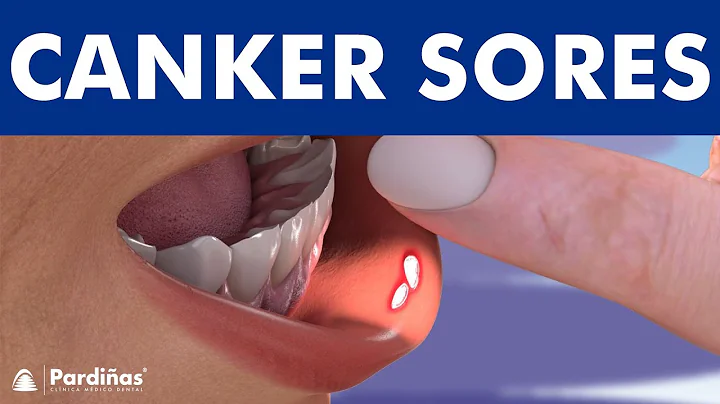 CANKER SORE - Treatment and mouth ulcer causes © - DayDayNews