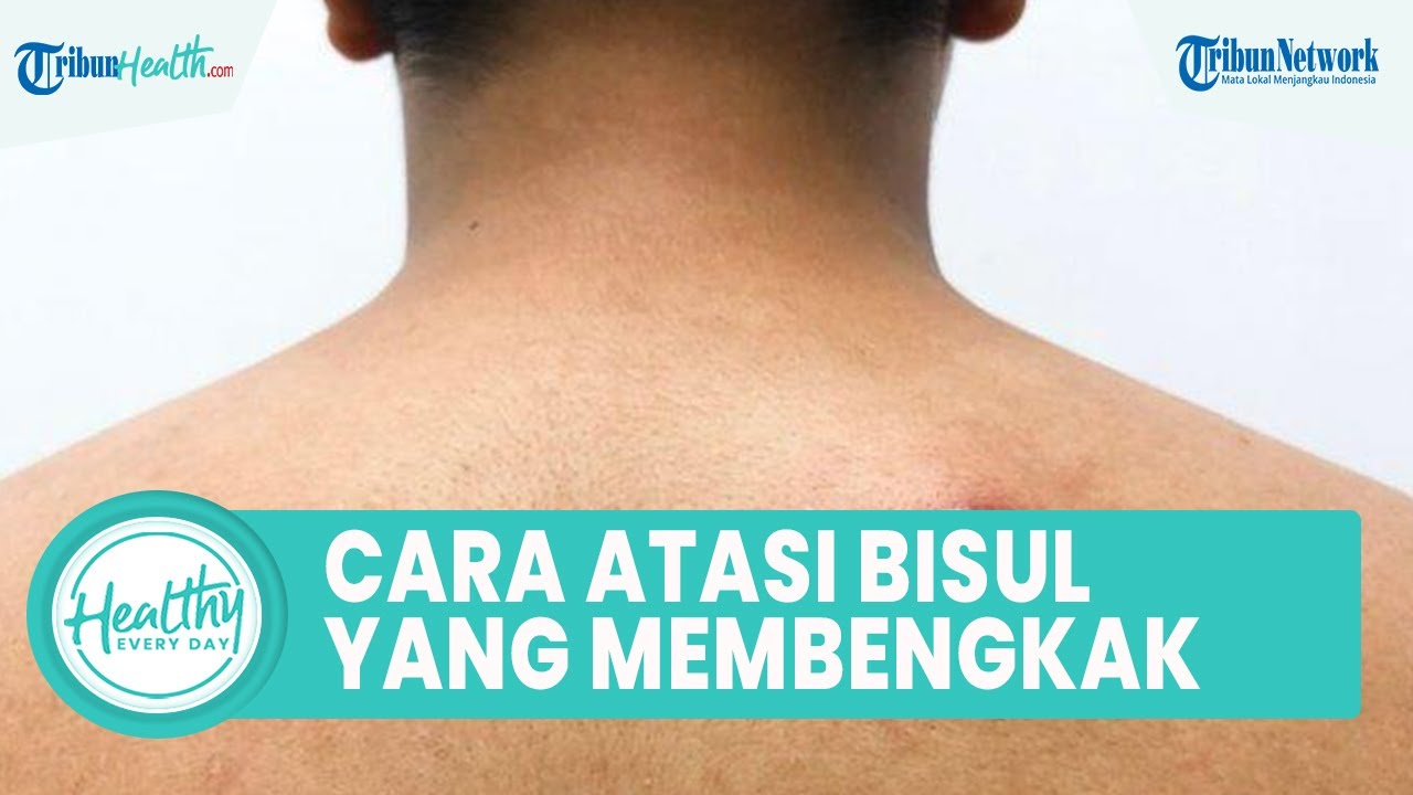 Bisul Dapat Bengkak lalu Jadi Penyakit Ganas, Begini Cara Tepat Atasi