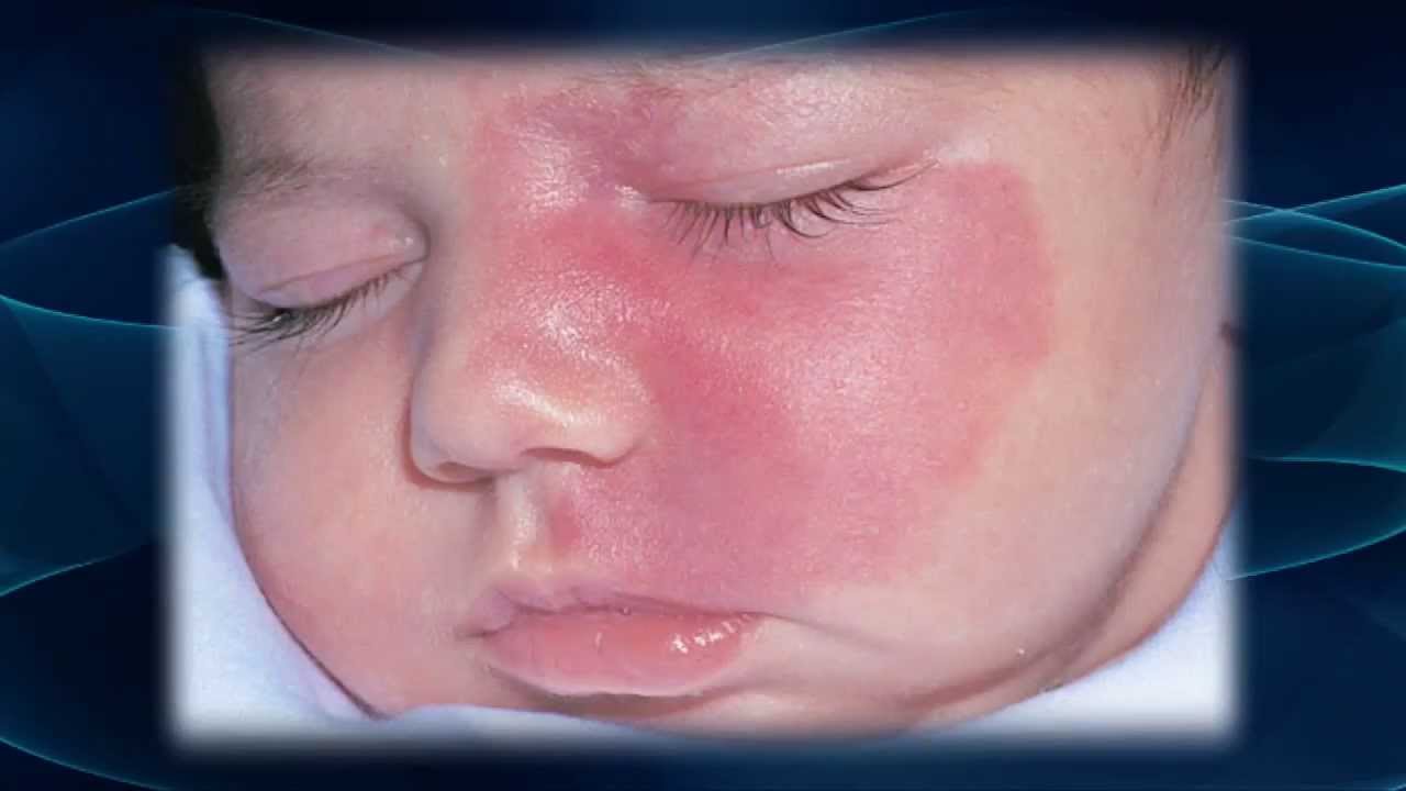 My Baby Has a Birthmark - YouTube