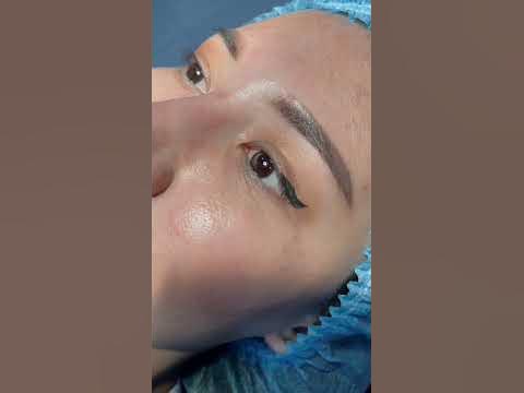 Сангапури + Эпикантопластика. +998999888397 - YouTube