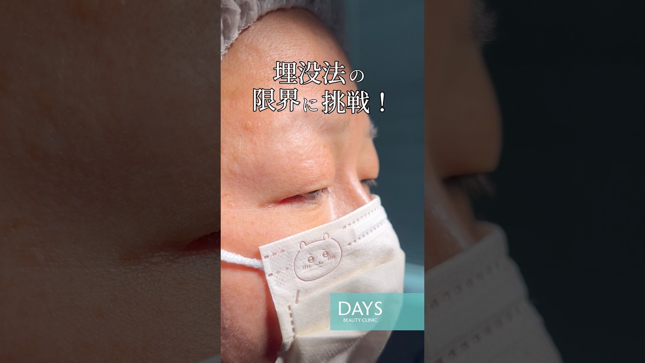 Double Eyelid Surgery] Shocking Before and After! #shorts - YouTube
