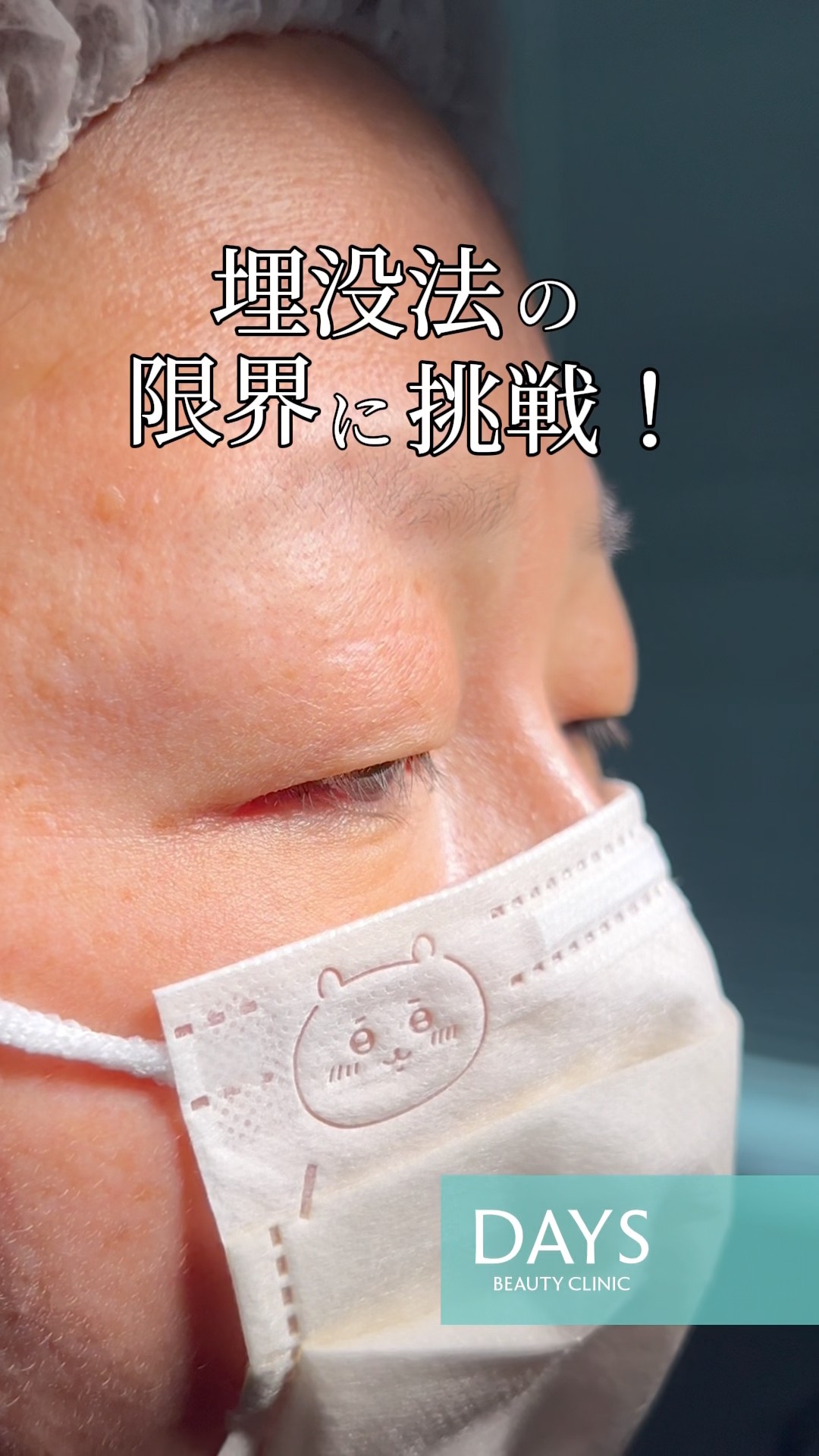 Double Eyelid Surgery] Shocking Before and After! #shorts - YouTube