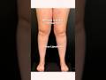 Lipedema is not normal fat legs. It is a disease. #legswelling #crazylegs #myleg #swollenlegs