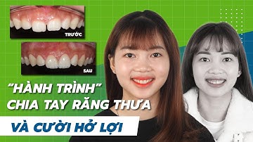Hành trình 4 tháng thay đổi nụ cười sửa Nụ cười hở lợi và khe thưa răng cửa
