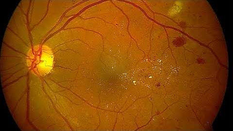 How to implement Diabetic Retinopathy | Tutorial| Query at +91-8283824812