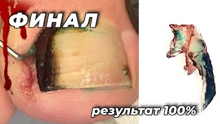 Работа на 1 млн #вросшиеногти