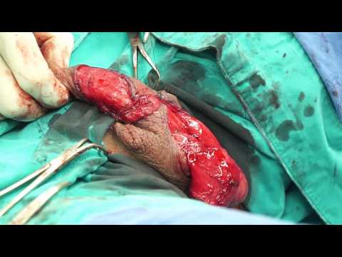 2 Stage Penile Paraffinoma Repair