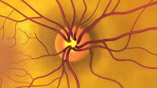 Detecting glaucoma animation