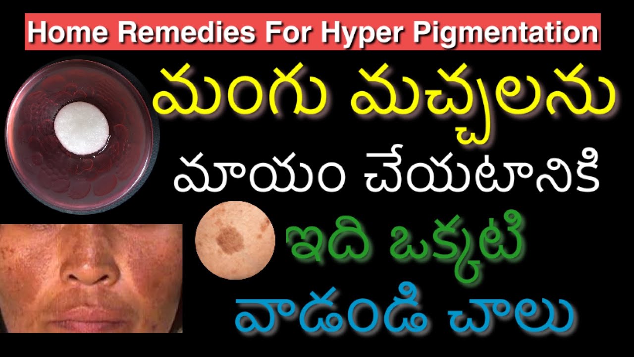 మంగు మచ్చలను మాయం చేయటానికి ఇది వాడండి చాలు / Hyperpigmentation Home