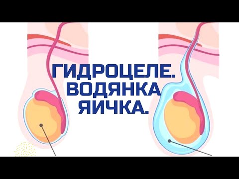 ГИДРОЦЕЛЕ. ВОДЯНКА ЯИЧКА. ПОЧЕМУ ВОЗНИКАЕТ. ЧТО ДЕЛАТЬ.