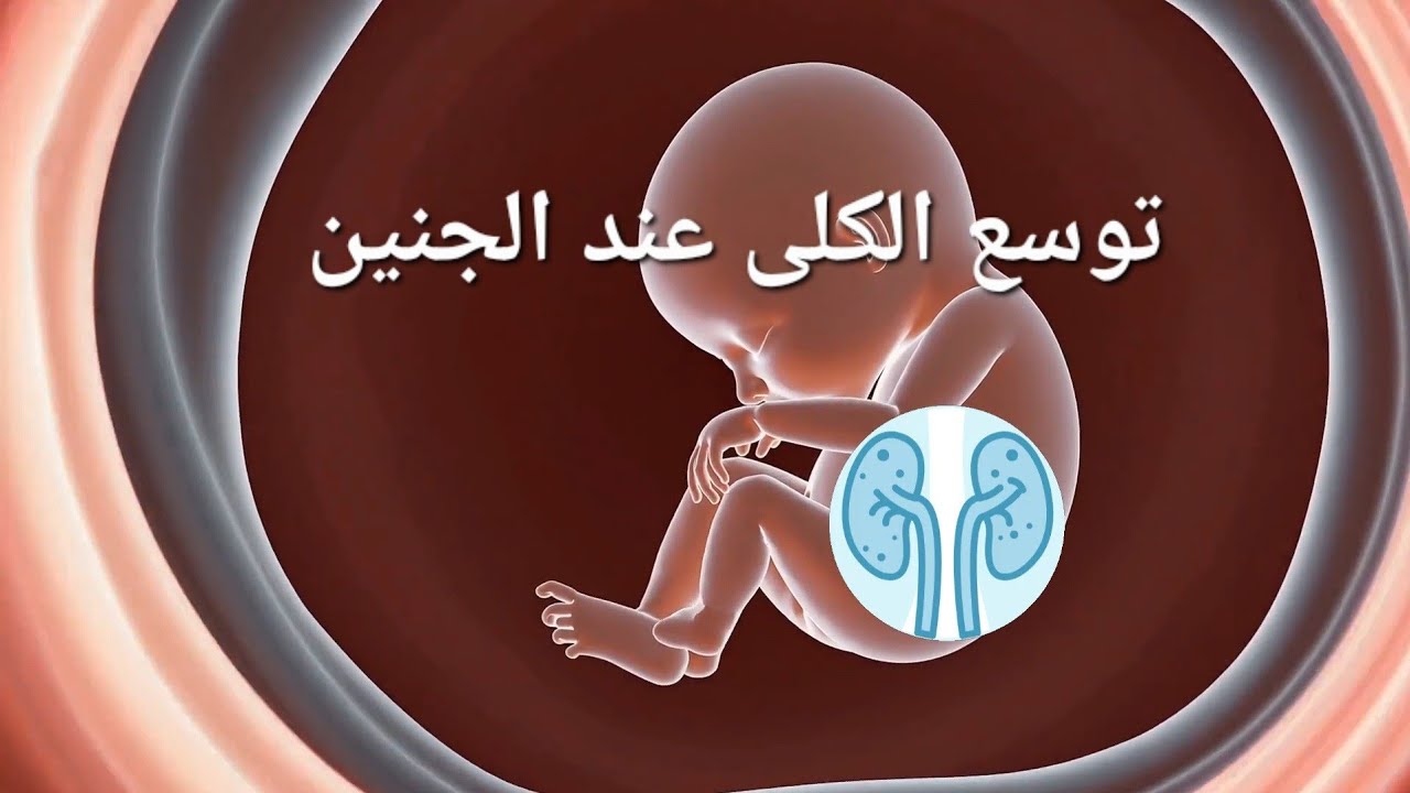 توسع حوض الكلى عند الجنين