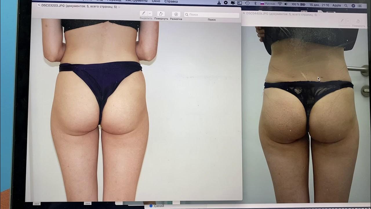 Pin on Doctor's Brazilian Butt Lift Procedures