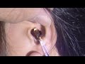 Classic Massive Earwax Removal