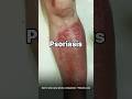 PSORIASIS: No More Scaling & Flaking 🇰🇷