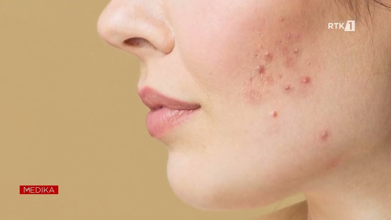 Medika - Çfarë është vezorja policistike? 25.02.2024