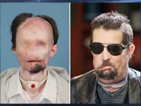 Man Shows Off First Us Full Face Transplant Man Shows Off First Us Full Face Transplant