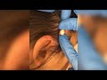 Compilation extrme points noirs  boutons  extractions les plus satisfaisantes 1