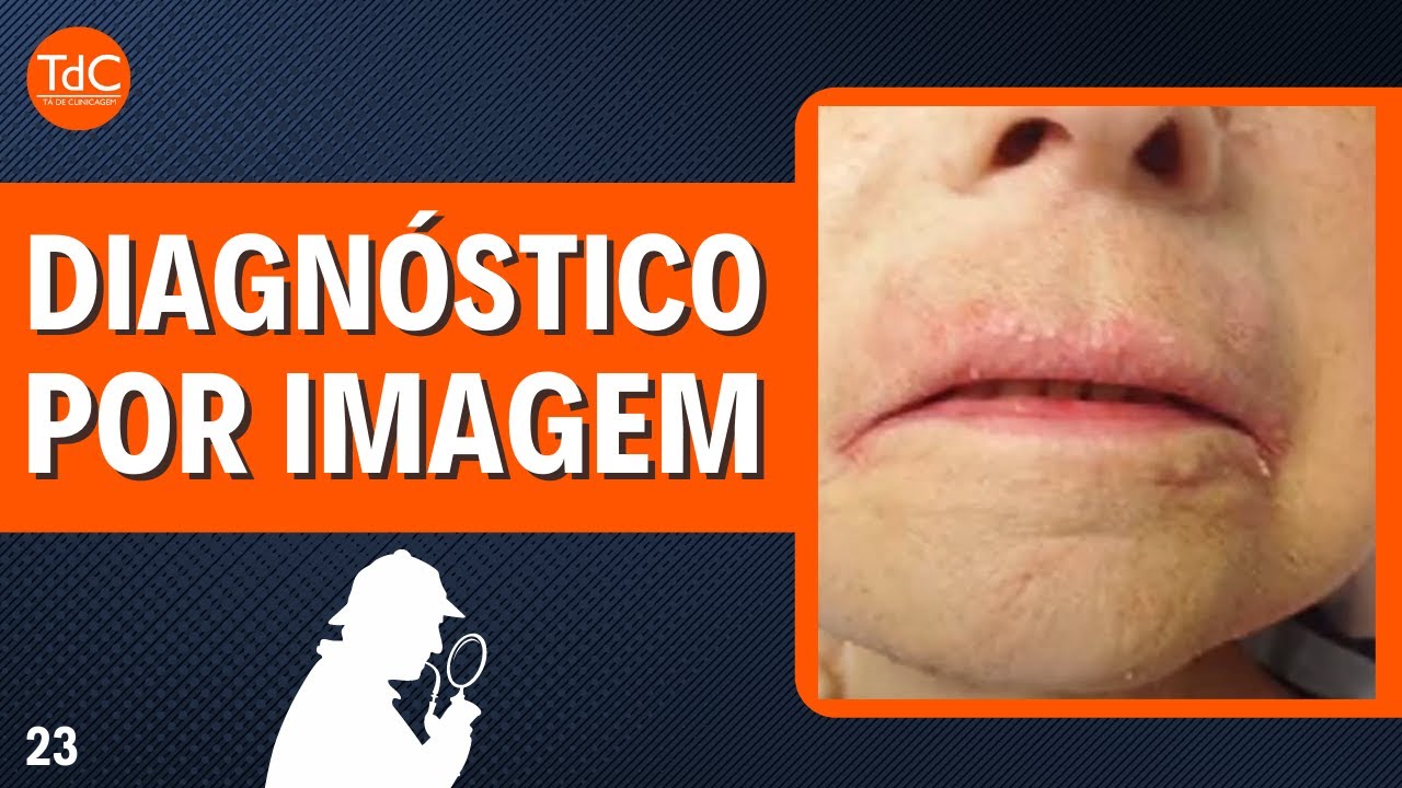 Thumbnail - "Lesões de pele após cirurgia bariátrica" l Desafio TdC 23