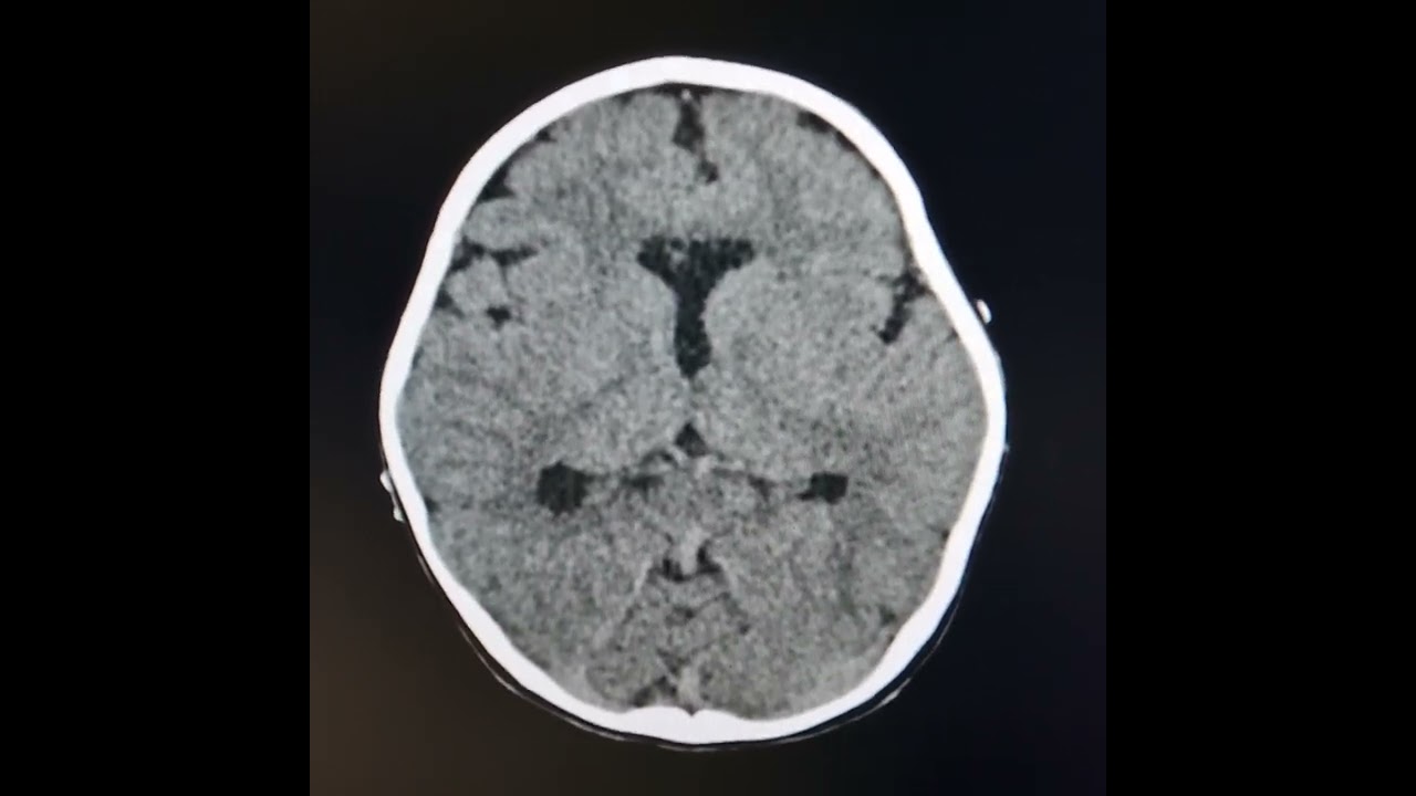 Lobar holoprosencephaly.