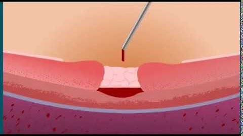 Macular Plug - Postop En Face OCT Demonstrating MH Closure in the Macular Plug Technique