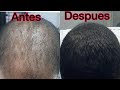 Minoxidil Barba | Como Aplicar de manera Correcta