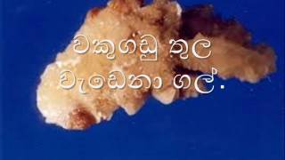 kidney  stone's
