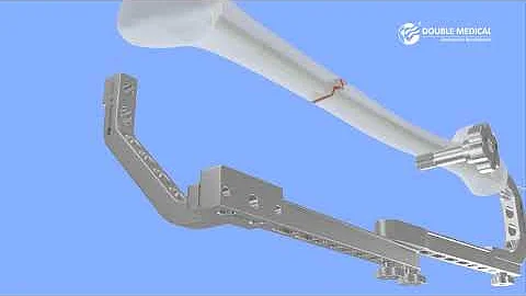 Double Medical Universal Femoral Nail UFN I