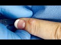 Wart or cyst extracting a bump on the finger   contour dermatology