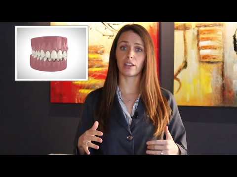Inman Aligner to Straighten your Front Teeth