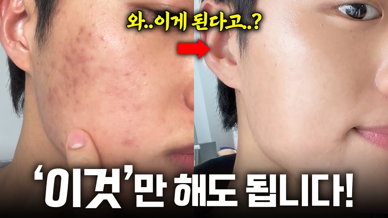 광고❌ 성인 여드름, 색소침착 피부🔥 였던 내가 피부 좋아진 이유
