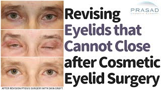 How Eyelids that Can't Fully Close after Cosmetic Surgery are Revised, and Avoiding Skin Shortages