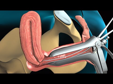 Medical Animation: Endometrial Biopsy