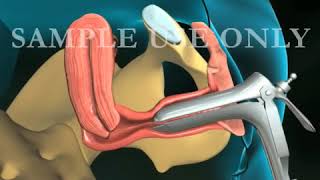 Endometrial Biopsy