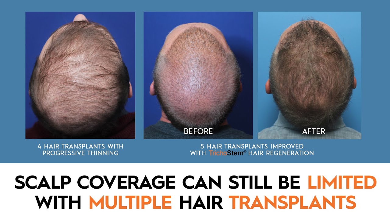 Why Multiple Hair Transplants Have Limits on Hair Density, Scalp Coverage, and Long-Term Results