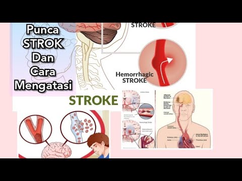 Video: Silent Stroke: Punca, Gejala, Rawatan Dan Banyak Lagi