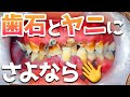 【歯石除去】歯石とヤニを徹底的に綺麗にします👏歯石とヤニにさよなら👋【彻底清洁牙齿结石和焦油】【Thoroughly clean tartar and tar】