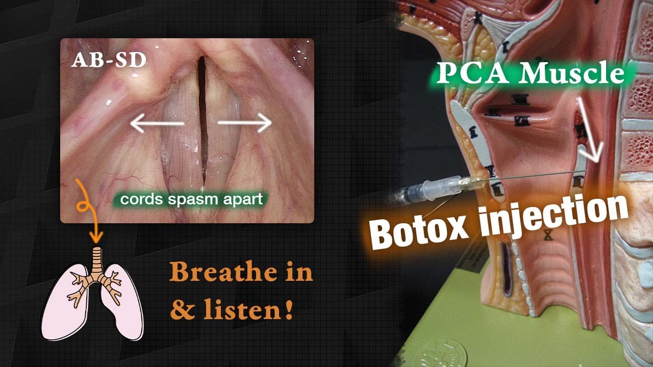 Vocal Cords Spasm Apart? | Abductory Spasmodic Dysphonia (AB-SD)