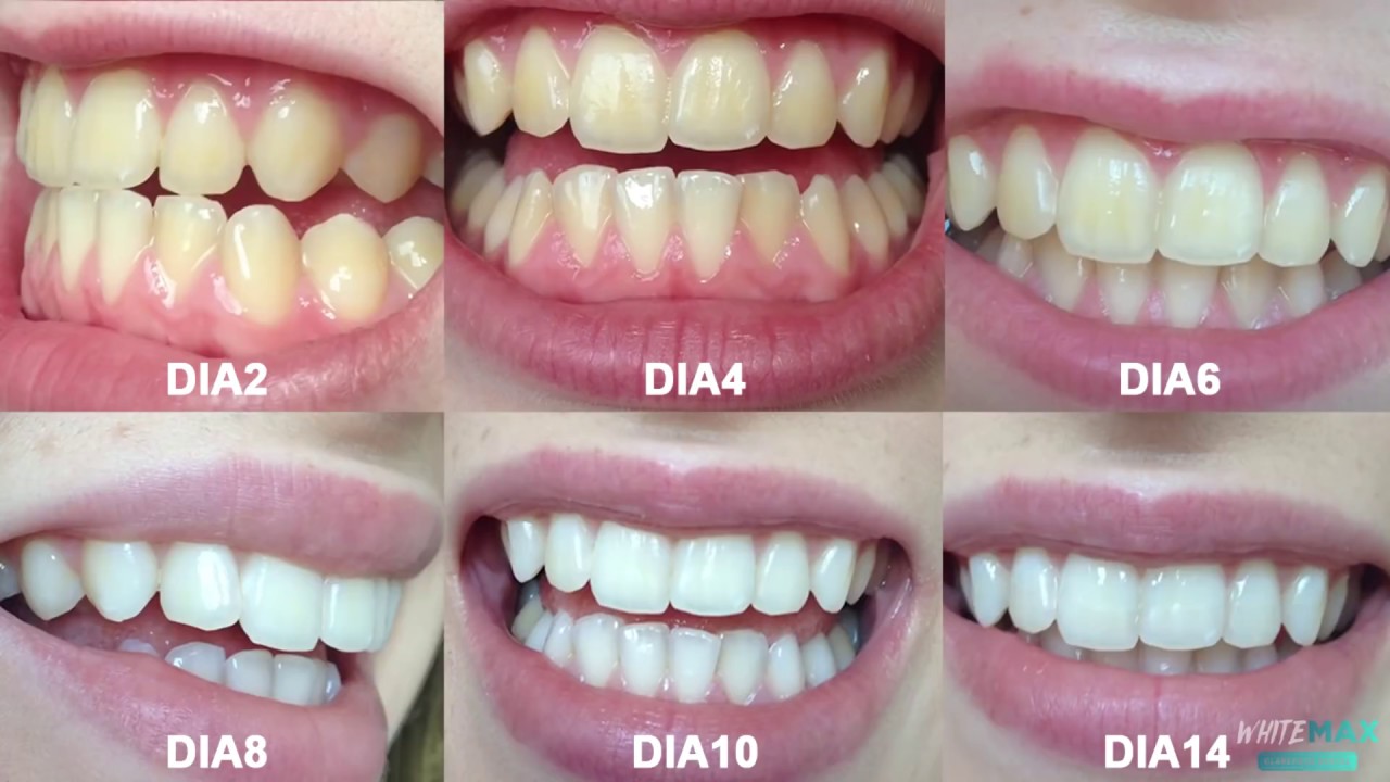 Clareamento dental caseiro com carvao