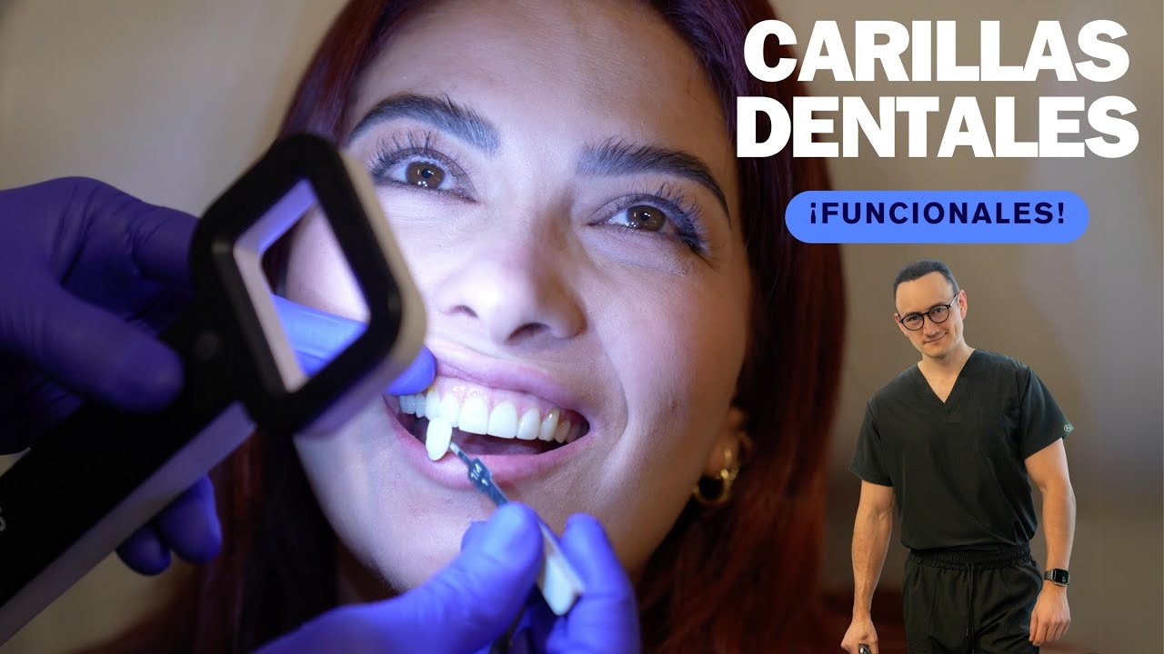 Se rompen fácilmente las carillas dentales? - IMaxilodental ¿Se rompen  fácilmente las carillas dentales?