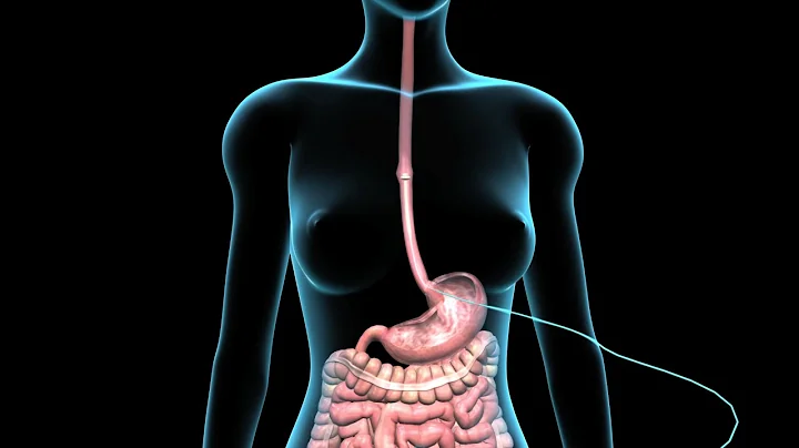 PEG | Feeding Tube | Nucleus Health