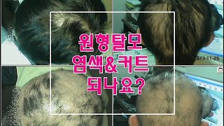 전두탈모! 다발성원형탈모 있을때! 헤어스타일과 염색 &amp; 커트시기는?