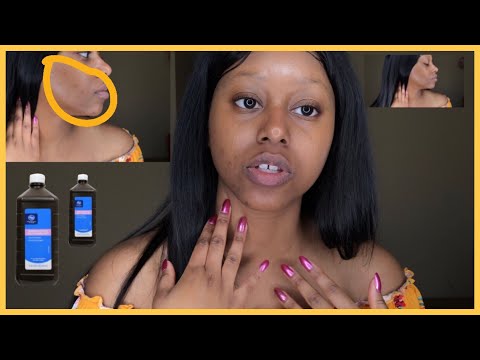 Using Hydrogen Peroxide for Hyperpigmentation & bumpy skin | 🇨🇩🇿🇦🇺🇸