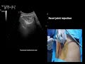 Ultrasound guided facet joint and transforaminal epidural steroid injection