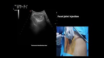 Ultrasound guided facet joint and transforaminal epidural steroid injection