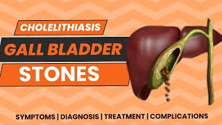 Cholelithiasis | GallStones | Gallbladder Stones | Symptoms | Diagnosis | Treatment | Complications
