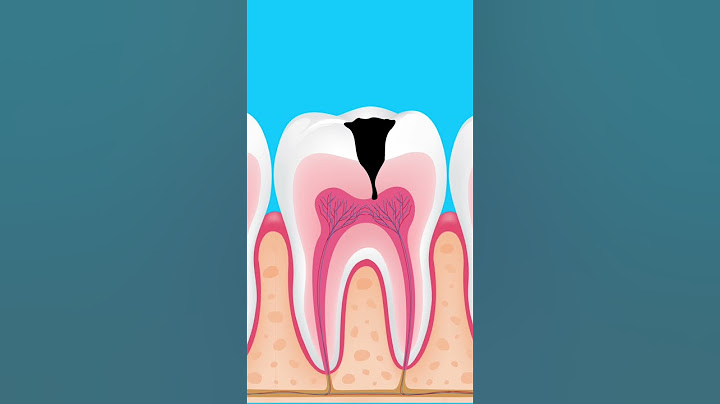 What happens if tooth decay is left untreated