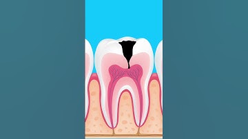 Thumbnail of What happens if tooth decay is left untreated